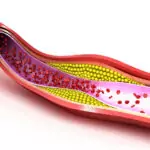 Атеросклерозата