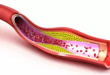 Атеросклерозата