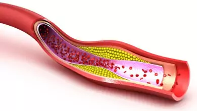 Атеросклерозата