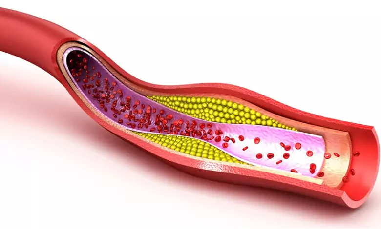 Атеросклерозата