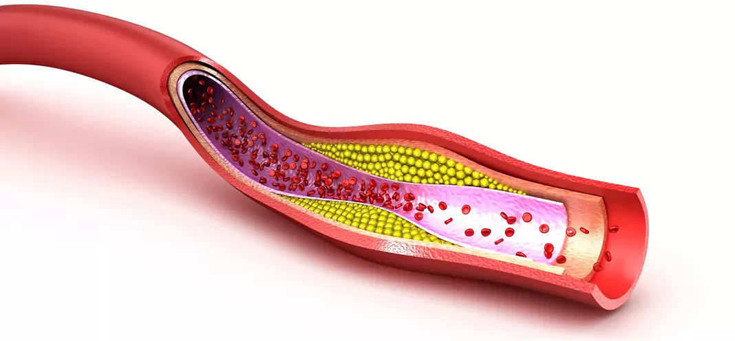 Атеросклерозата