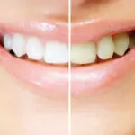 Как лесно да премахнем зъбната плака