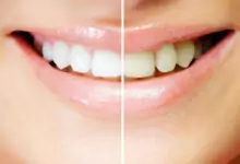 зъбната плака