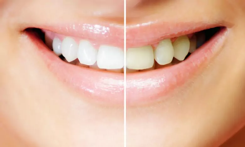 зъбната плака