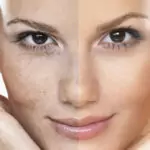 Изгонете старческите петна