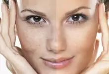 пигментация