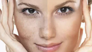 пигментация