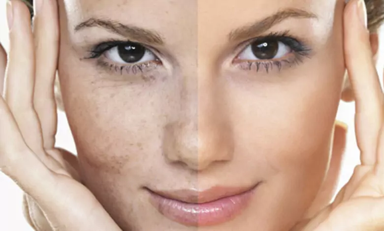 пигментация