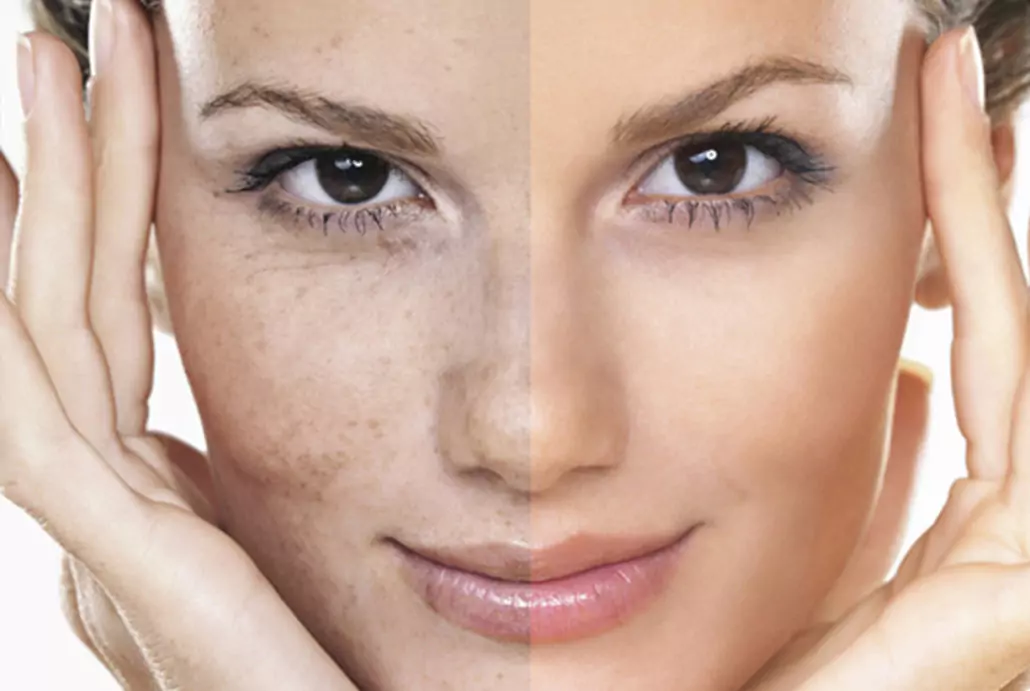 пигментация