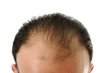 hair loss