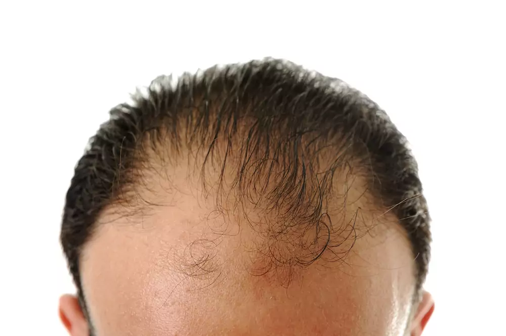 hair loss
